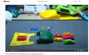 Prothèse 3D